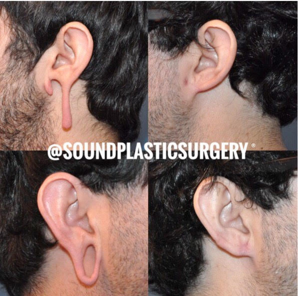 pointy ear surgery