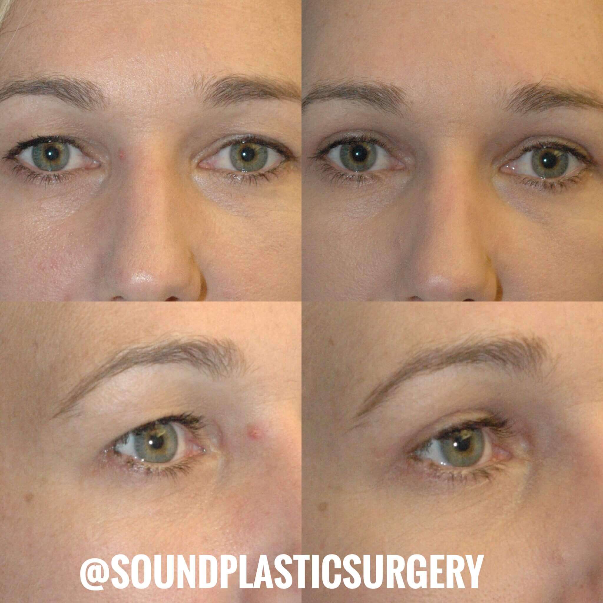 eyelid surgery seattle