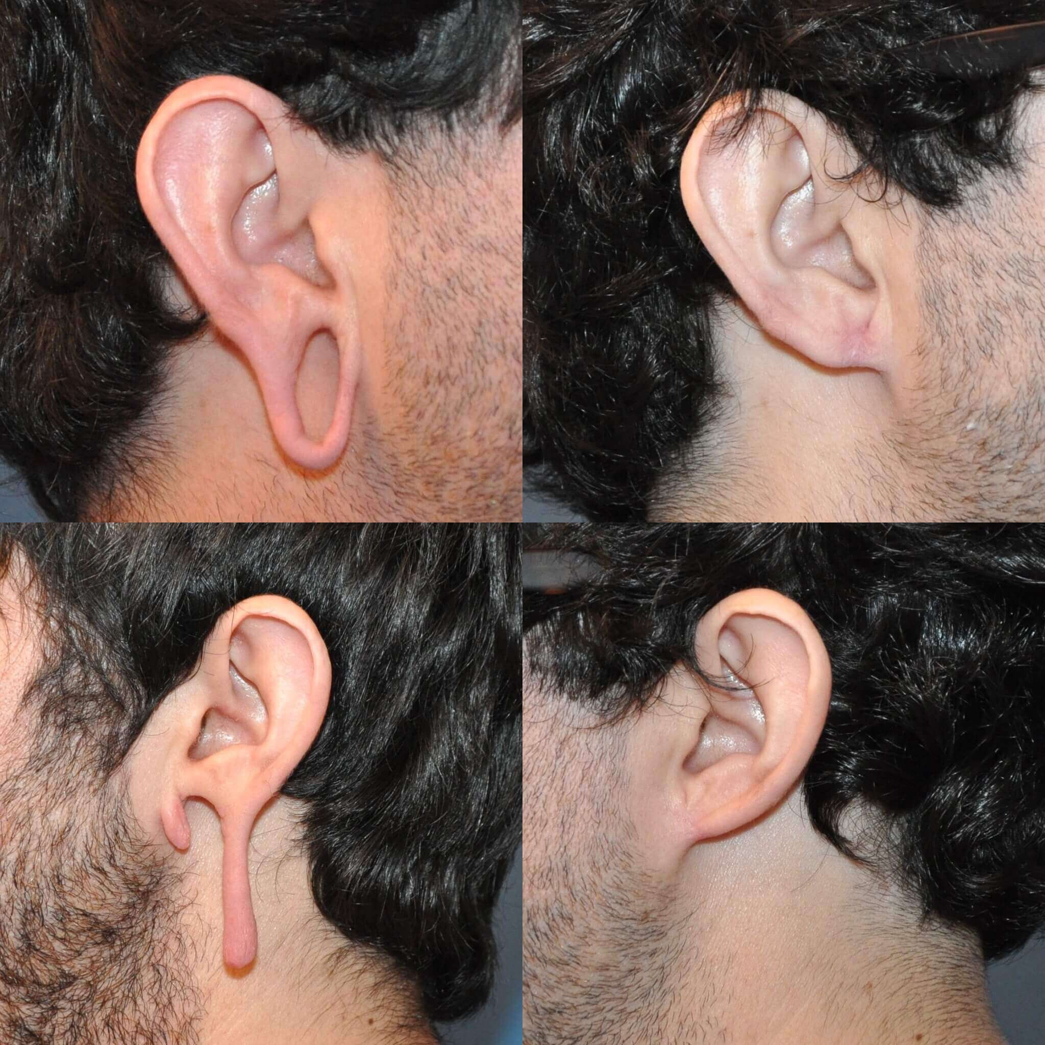 Ear Lobe Cosmetic Repair Clinic