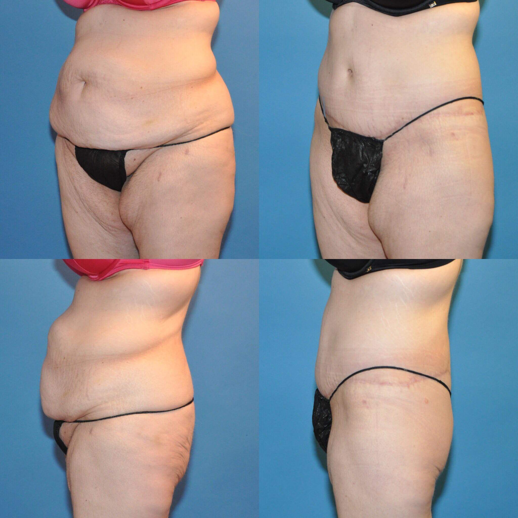 Circumferential Lower Body Lift  Sound Plastic Surgery, Cosmetic Plastic  Surgery Clinic Seattle