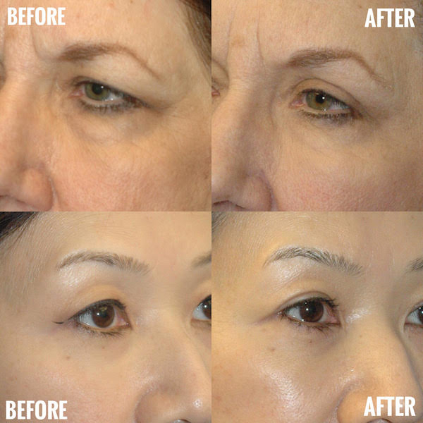 Eyelid Surgery Sound Plastic Surgery Cosmetic Plastic Surgery