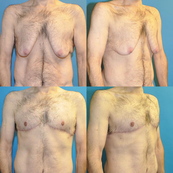 Gynecomastia Surgery Male Breast Reduction Sound Plastic