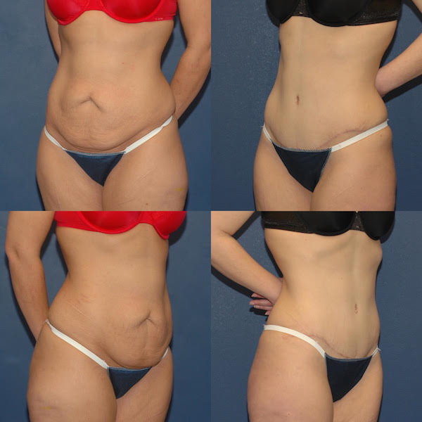 Tummy Tuck Surgery: Let's Talk about Scarring - Signature Plastic Surgery