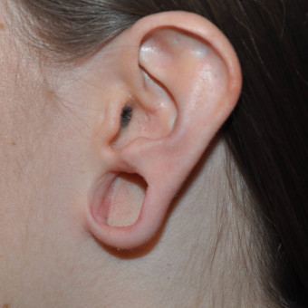 Earlobe Repair Surgery  Sound Plastic Surgery, Cosmetic Plastic Surgery  Clinic Seattle