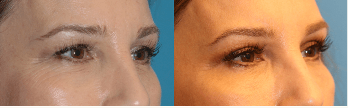 Eyelid surgery seattle new arrivals