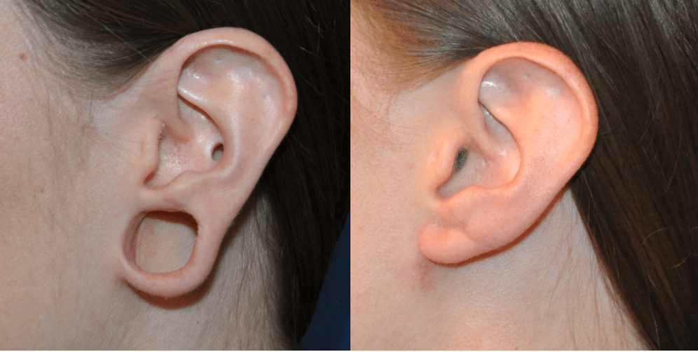 Earlobe Repair: What You Need To Know