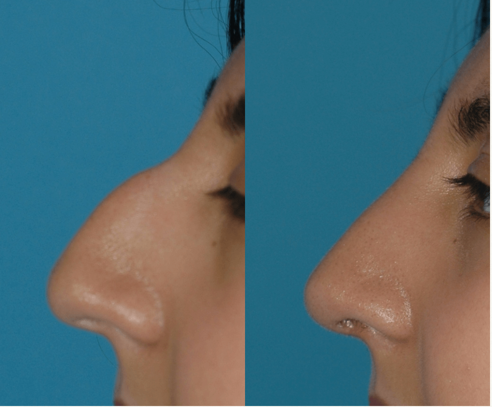 What is Cosmetic Surgery of the Nose?