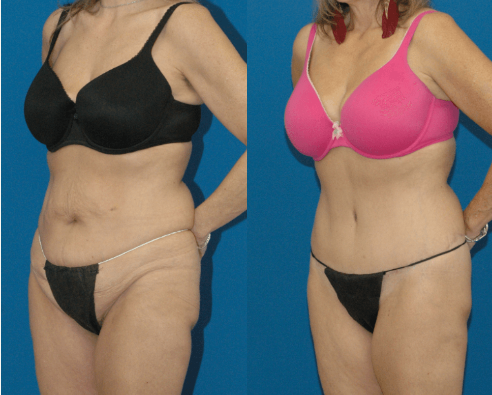 Body Contouring Surgery Cost