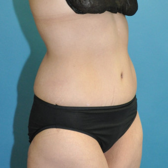 Post op right oblique 11 months