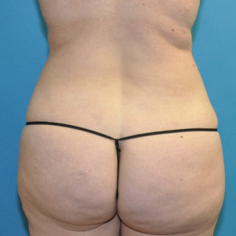 Post op posterior